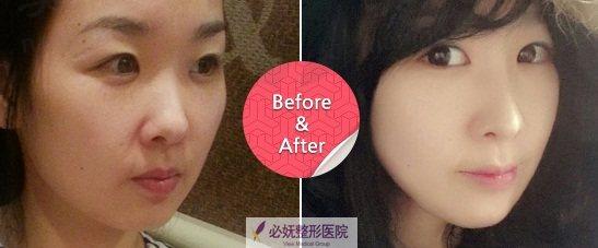 我做必妩隆鼻手术，告别塌鼻梁，精致侧颜和自信都回来了！ 